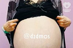 30-килограммовая опухоль выросла на яичнике россиянки